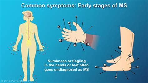 Numbness Or Tingling In The Hands Or Feet Is Another Common Symptom In