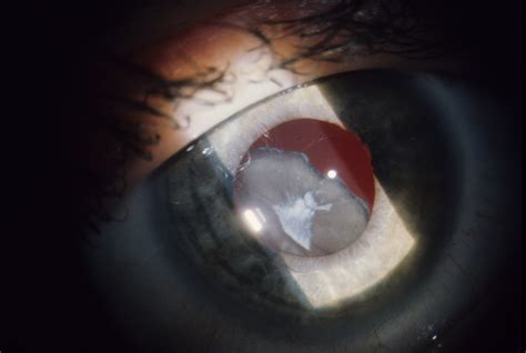 Marfan Syndrome Hereditary Ocular Diseases