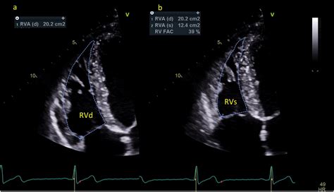 Echocardiographic Assessment Of The Right Ventriclestate Of The Art