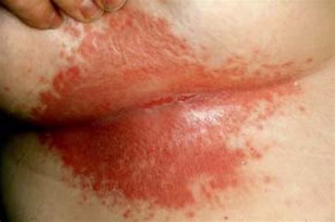 Intertrigo (intertriginous dermatitis) is an inflammatory condition of skin folds, induced or aggravated by heat, moisture sections intertrigo. Intertrigo : INTERTRIGO TRATAMIENTO PDF - Intertrigo is a ...