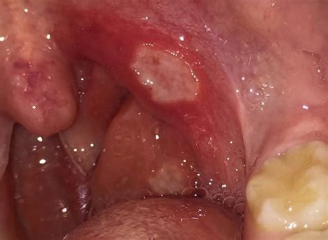 Major Aphthous Ulcers On The Tonsil And Palatoglossal Arch Prior To