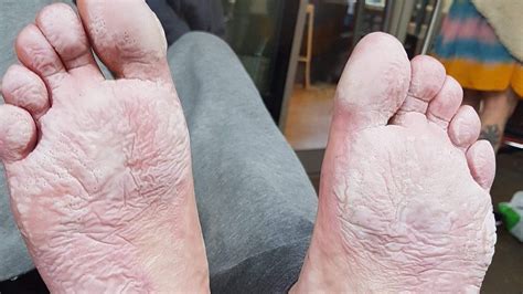 Trench Foot Rife Amongst Wales Homeless Bbc News