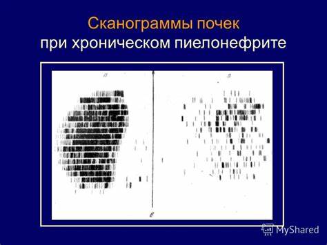 При хроническом пиелонефрите назначают диету