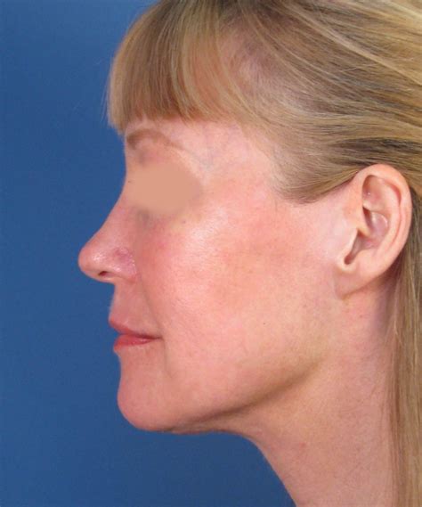 San Diego Well Healed Facelift Incision
