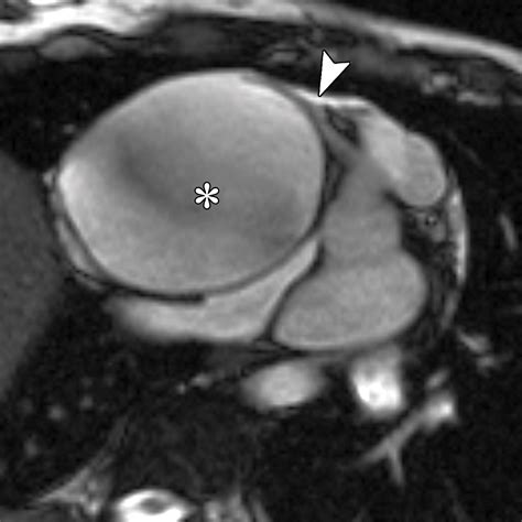 Spectrum Of Coronary Artery Aneurysms From The Radiologic Pathology