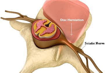 Sciatica Treatment Center In South Florida Spine Orthopedic Center