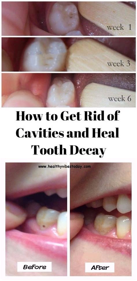 How To Tell If You Have A Cavity At Home