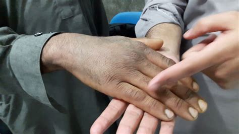 Wrist Drop Examination Radial Nerve Palsy Youtube