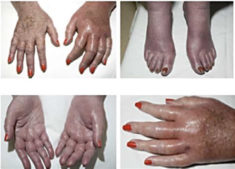 What Is It Like To Live With Erythromelalgia