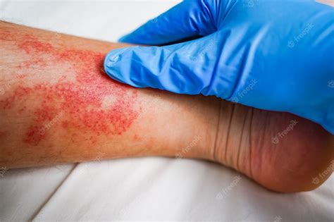Premium Photo Disease Of The Skin On The Legs Itchy Red Rashes And Spots