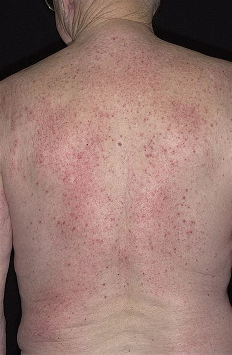 Eczema On The Back Pictures 40 Photos And Images