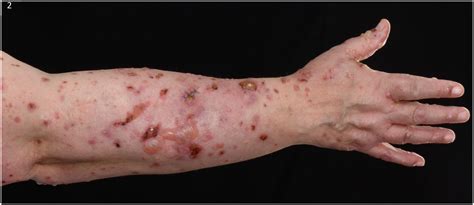 Bullous Pemphigoid In A Patient With A Neuropsychological Disorder And
