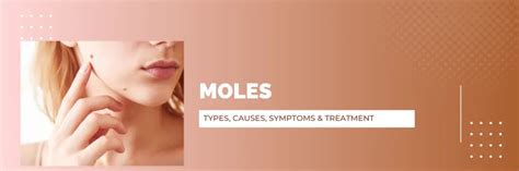 Moles Types Causes Symptoms And Treatment