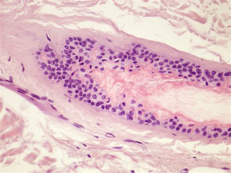 A new approach to the prevention and cosmetic treatment of alopecia aminexil. Clinical case - Dermatopatologia ...