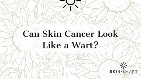 Can Skin Cancer Look Like A Wart Youtube