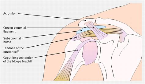 Shoulder impingement syndrome is a syndrome involving tendonitis (inflammation of tendons) of the rotator cuff muscles as they pass through the subacromial space, the passage beneath the acromion. Effect of specific exercise strategy on need for surgery ...