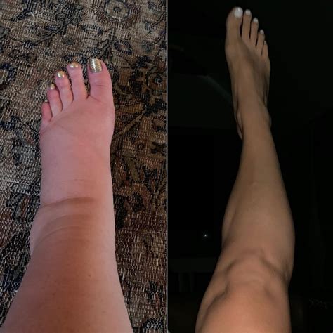 Jessica Simpsons Postpartum Ankle Pic After Swollen Pregnancy Feet