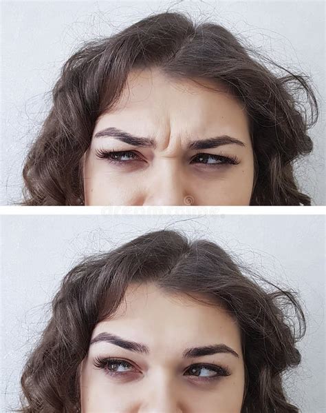 Forehead Woman Wrinkles Before And After Stock Image Image Of