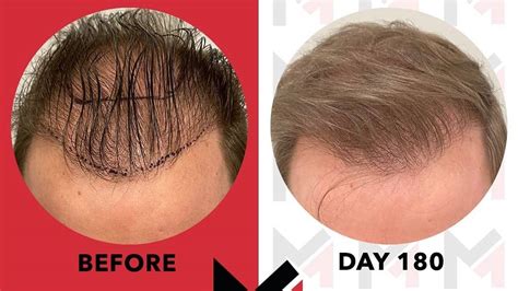 Stem Cell Hair Therapy Restore Growth Of Natural Hair Follicles New