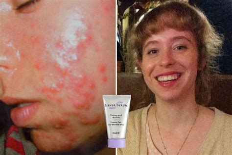 Woman Suffering Worst Case Of Acne Is Cured After 10 Years Thanks