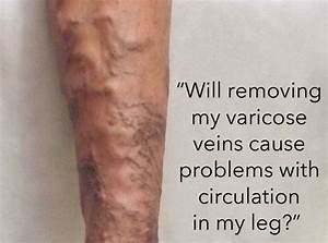 Effect of Varicose Vein Removal on Circulation - Totality  Heart and Circulation Varicose Veins