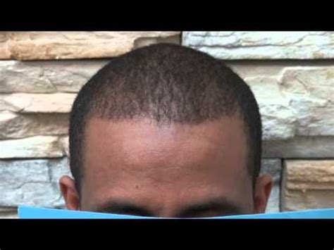★★★★★guard your hair before you lose it. Black Hair Loss Hairline Restoration FUE Hair Transplant ...