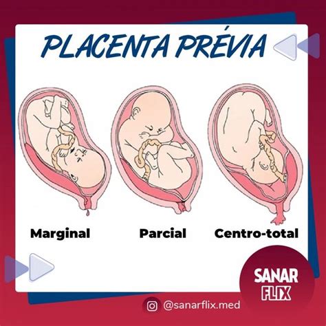 Resumo Sobre Placenta Prévia Colunistas Sanarmed