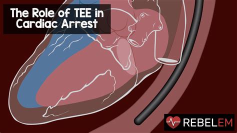 The Role Of Tee In Cardiac Arrest Rebel Em Emergency Medicine Blog
