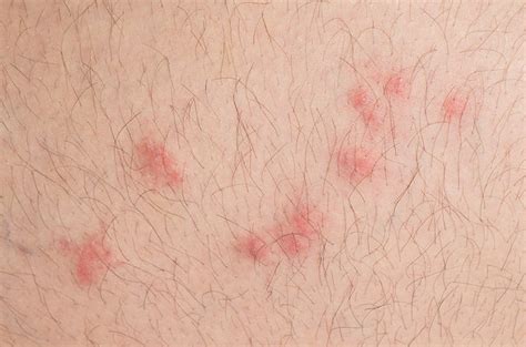 Flea Allergy Dermatitis On Humans