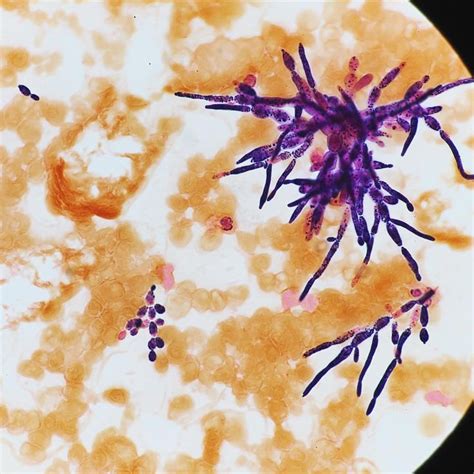 Captivating Candida Species In A Gram Stain