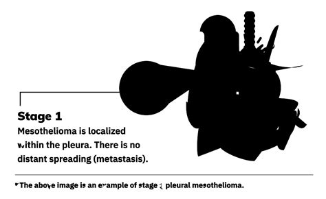Clinical staging and the tendency of malignant pleural mesotheliomas to remain localized. 4 Mesothelioma Stages | Staging Systems & Treatment by Stage