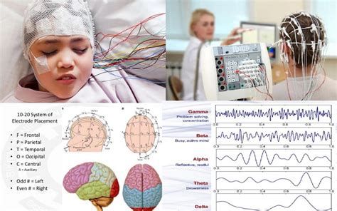 Electroencefalograma Eeg Neurologie Pediatrica