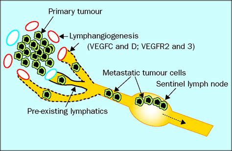 Lymphatic Dissemination Of Tumour Cells And The Formation Of
