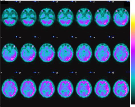 Perfusion Spect Imaging Of The Brain Performed With Tc 99m Edc