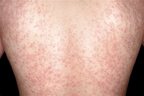 Pityriasis Rosea Stamford Skin Centre