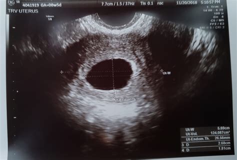 My Blighted Ovum Miscarriage Part 1