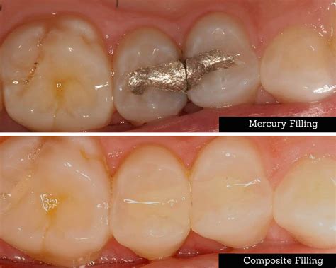 Patient:wow, that's a load off my mind. What are Composite Fillings (AKA White Fillings)? - United ...