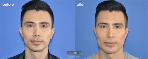 Chin Implant Before And After Celebrities