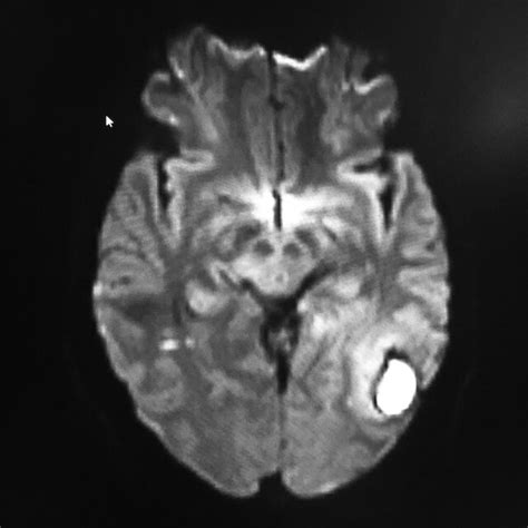 Mri Brain Showing Intracerebral Hematoma In The Left Parieto‐occipital