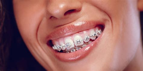 How to Prevent White Spots From Braces - Family First Dentistry