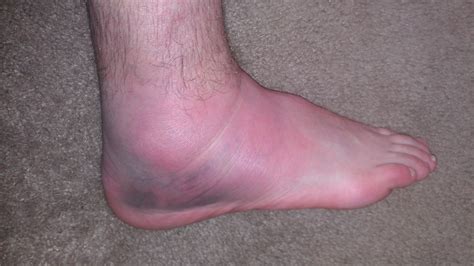 Swelling And Pain In The Ankle After Knee Surgery What You Should Know