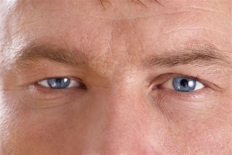 Maybe you would like to learn more about one of these? Ptosis | Long Island | Drooping Upper Eyelids | SightMD