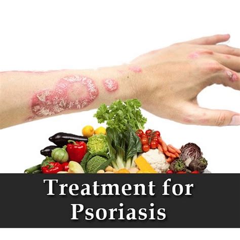 Psoriasis Natural Treatment Youtube
