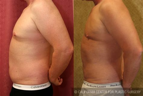 Patient Male Liposuction Abdomen Before And After Photos Encino