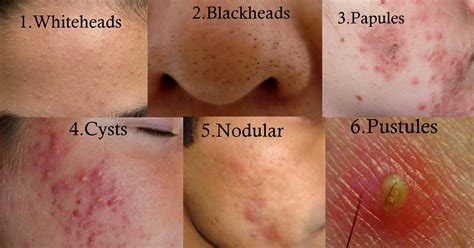 Nodular Acne Vs Cystic Acne Google Search Cystic Acne Treatment Oily