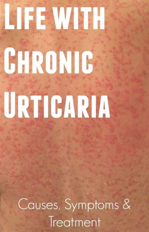Life With Chronic Urticaria The Dad Network Urticaria Chronic