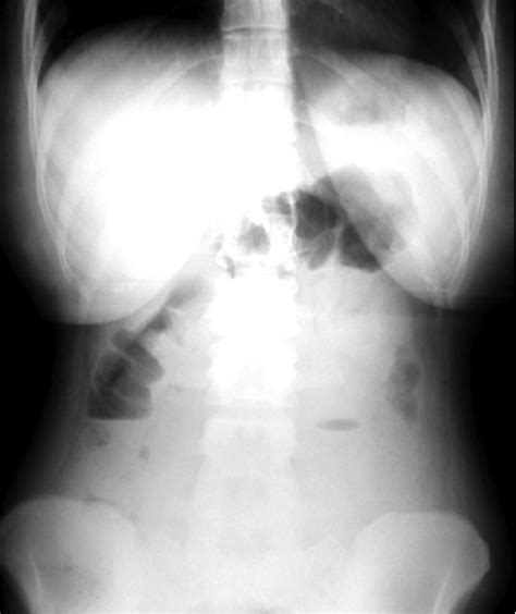 Plain Abdominal Radiograph On Patient Presentation Showed Only Moderate