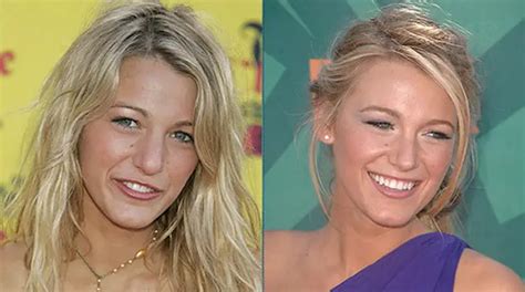 Blake Lively Breast Implants Nose Job Plastic Surgery Before And After Celebie