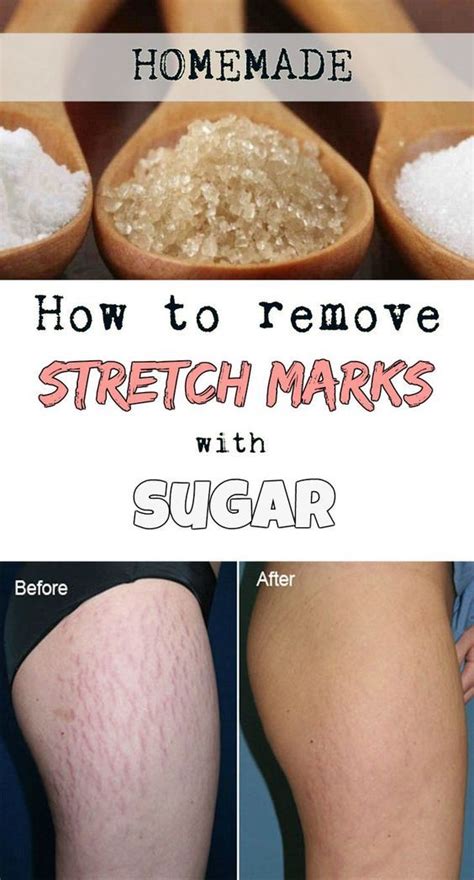 How To Remove Stretch Marks With Sugar Diy Stretch Marks Cream