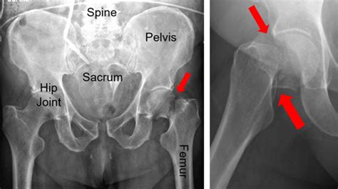 Young Patients With Femoral Neck Fracture Orthopaedic Trauma